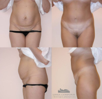 Abdominoplastyka - operacja powłok brzucha
